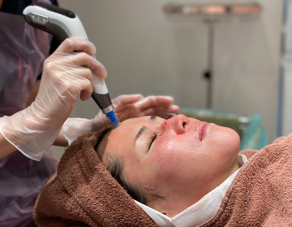 ヴァンパイアフェイシャルとは