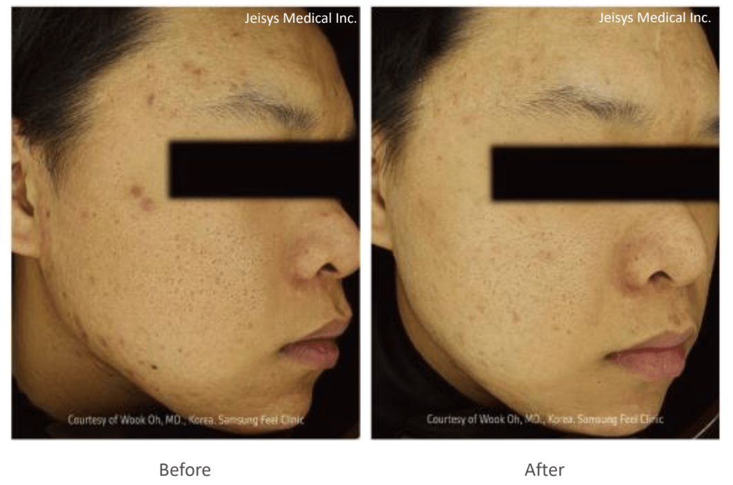 ポテンツァ（Acne Scar）