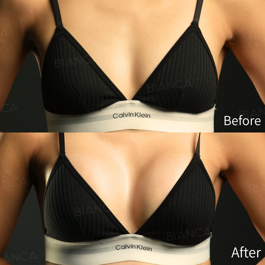 PRESERVé™ シリコンバッグ豊胸