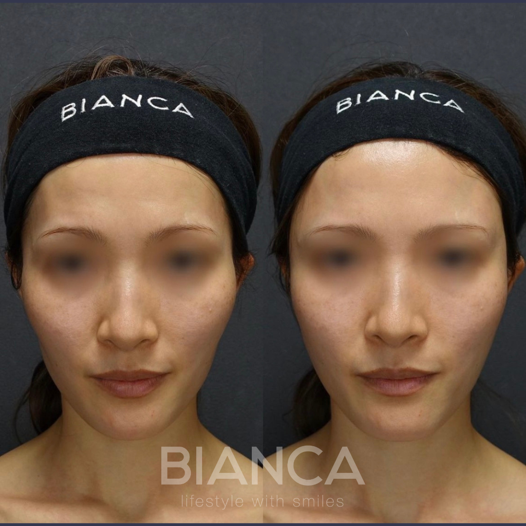 頬・こめかみヒアルロン酸注入