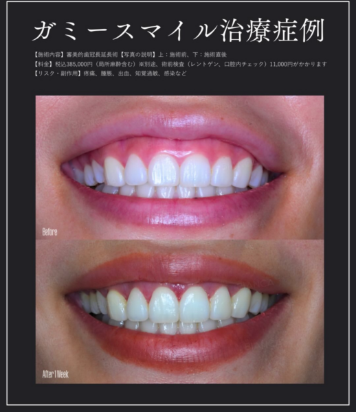 【銀座限定】歯茎でお悩みの方に✨築山医師によるガミースマイル専門治療👄