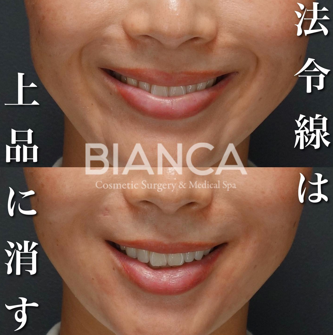 ヒアルロン酸注入