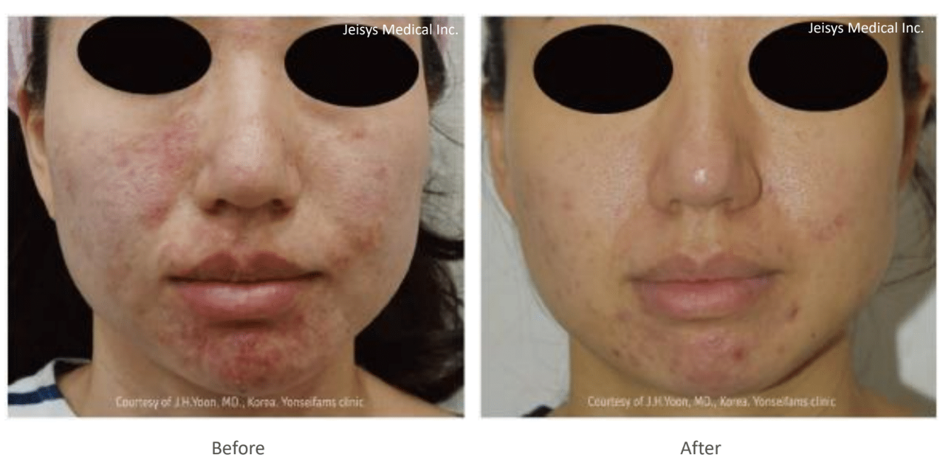 ポテンツァ（Acne）