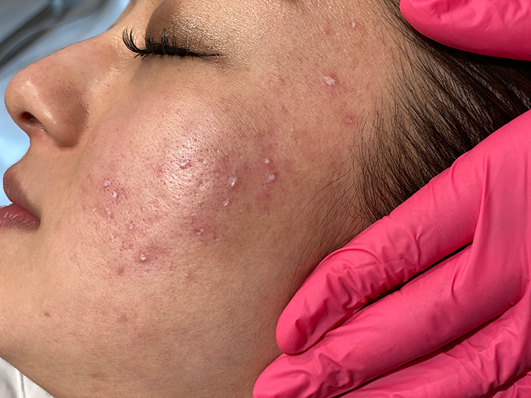 TCAクロス（クレーター治療）とは