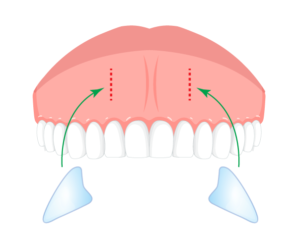 鼻翼基部プロテーゼ（貴族手術） ビアンカ銀座｜日本を代表する美容健康再生医療のクリニック