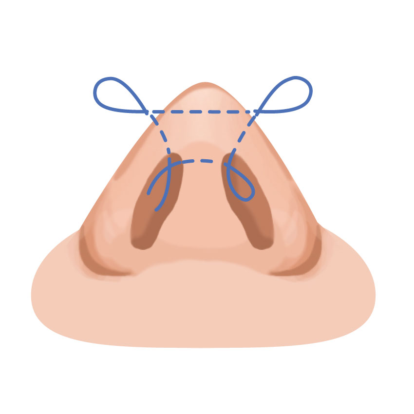 鼻尖縮小（埋没法）・だんご鼻修正