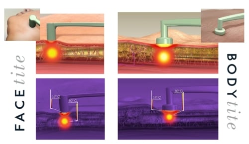 効率良く引き締めるRFALテクノロジー搭載