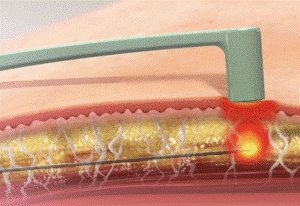 部位に適したハンドピースを使い分け