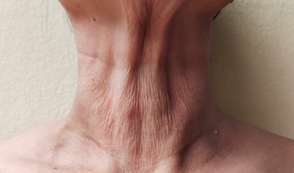 シワ・くぼみのお悩み