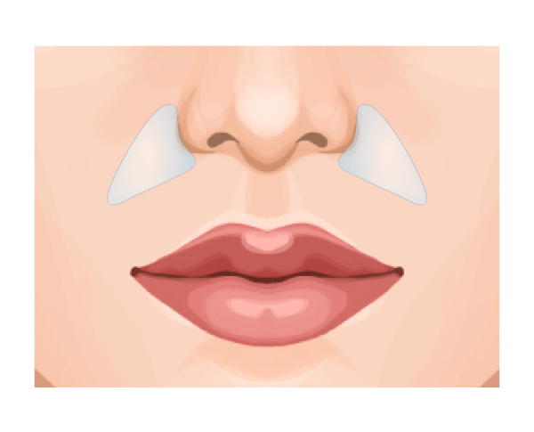 鼻翼基部プロテーゼ（貴族手術） ビアンカ銀座｜日本を代表する美容健康再生医療のクリニック