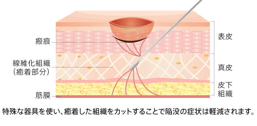 サブシジョン（クレーター治療）とは