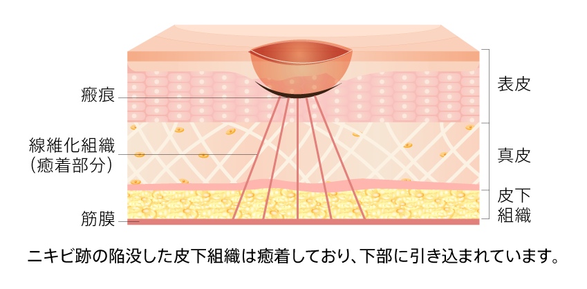 サブシジョン（クレーター治療）とは