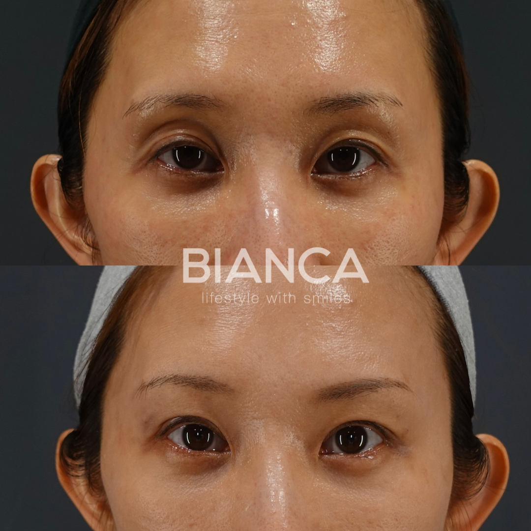 眼瞼下垂切開法