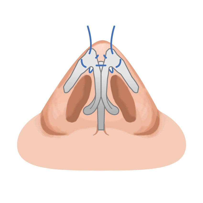 鼻尖形成 ビアンカ銀座｜日本を代表する美容健康再生医療のクリニック