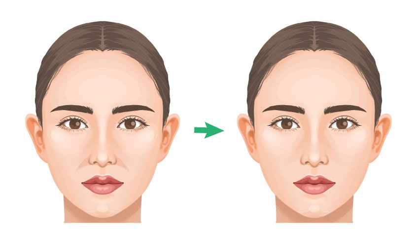 鼻翼基部プロテーゼ（貴族手術） ビアンカ銀座｜日本を代表する美容健康再生医療のクリニック