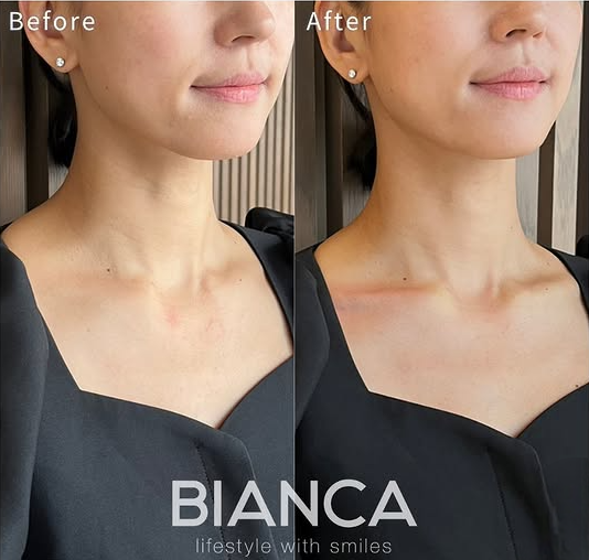 鎖骨ヒアルロン酸注入