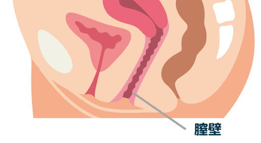 膣壁形成（膣縮小手術）