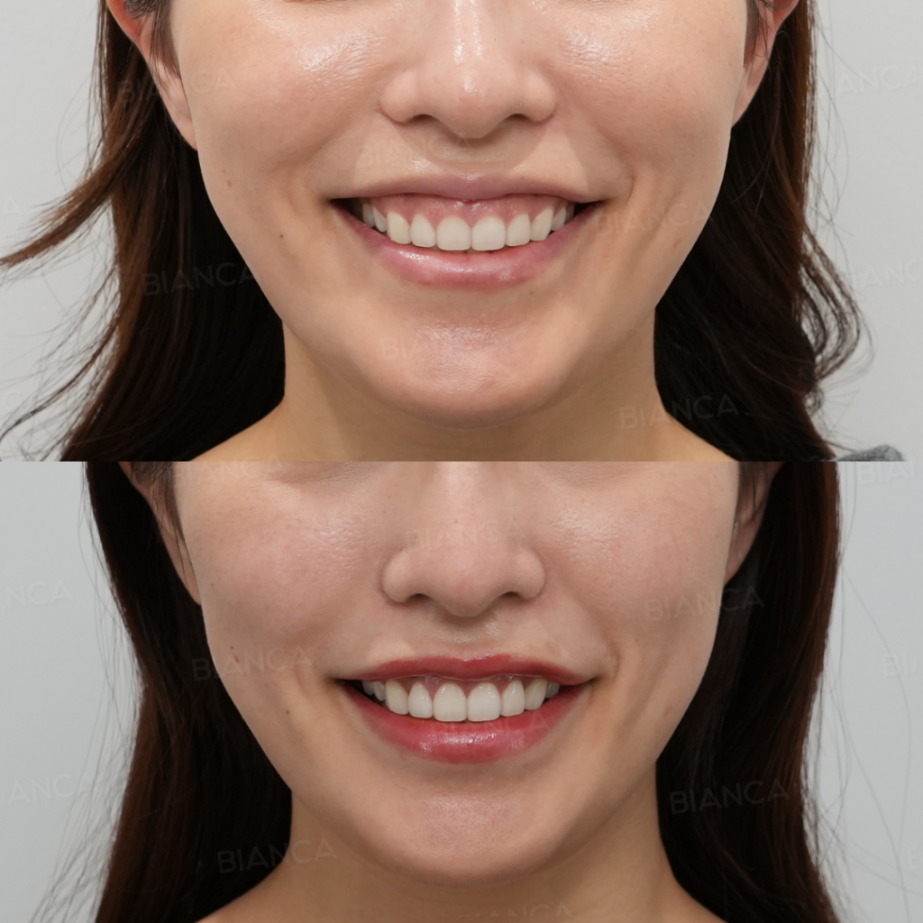 審美的歯冠長延長術