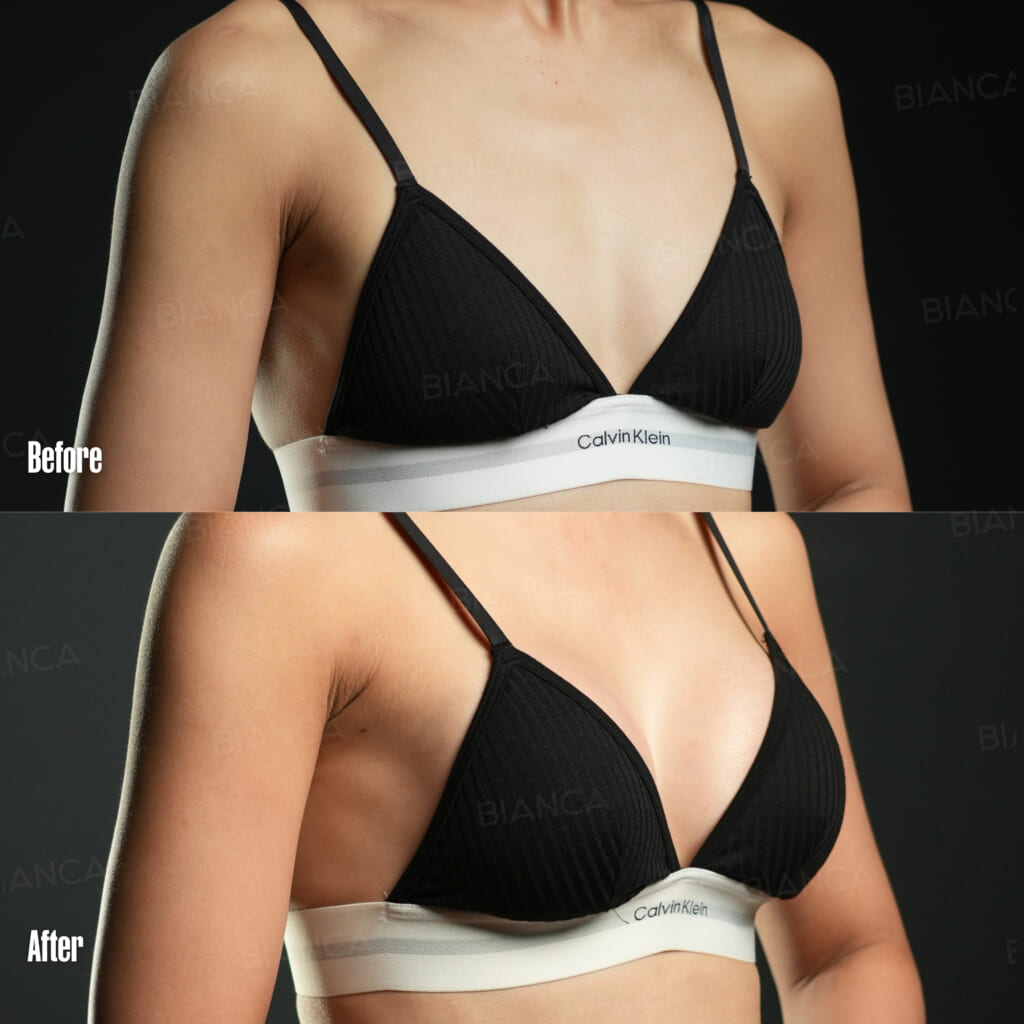 豊胸のダウンタイムは？術後経過と回復目安の解説