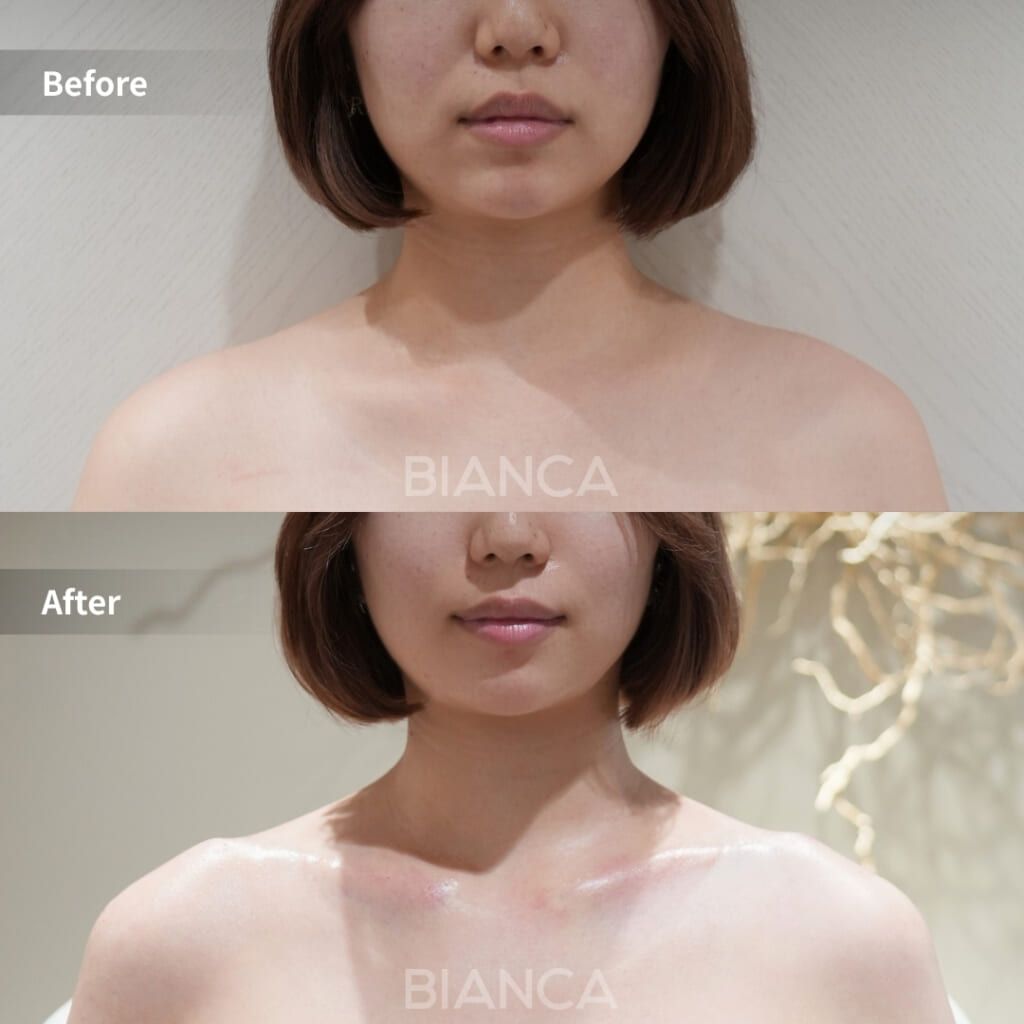 ヒアルロン酸注射(肩)|銀座・表参道にあるBIANCA CLINIC ビアンカ ヒアルロン酸注射(肩)|銀座・表参道にあるBIANCA CLINIC ビアンカ