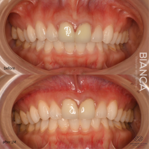 リップリポジショニング