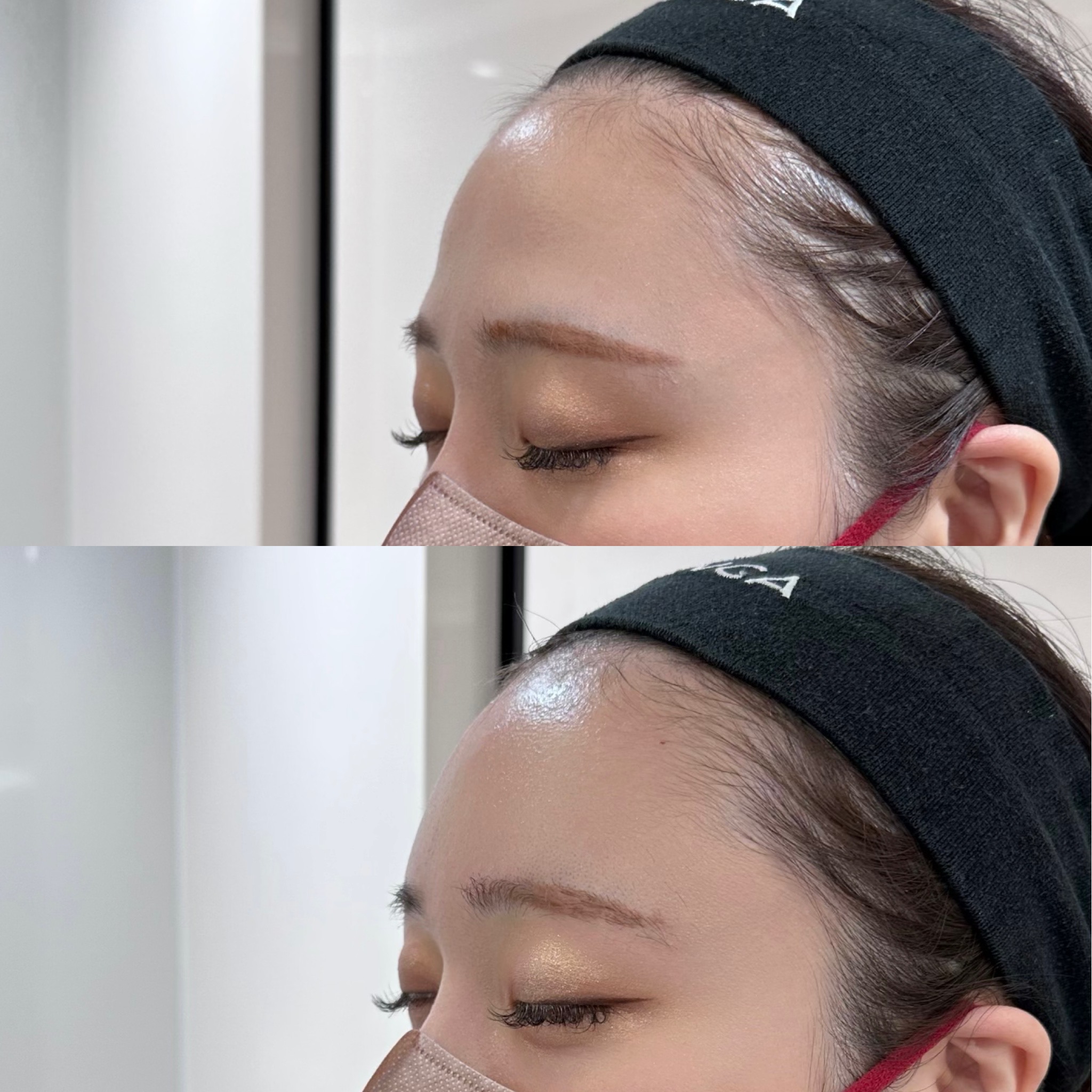 ヒアルロン酸注射（額）