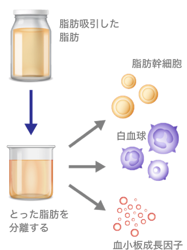 【豊胸】脂肪注入で作る自然なバスト！魅力とリアルを医師が解説｜銀座・表参道にあるBIANCA CLINIC ビアンカクリニック｜美容外科・美容皮膚科・再生医療・美容婦人科・美容内科・医療アートメイク