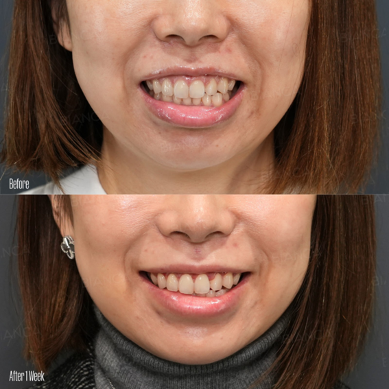 審美的歯冠長延長術