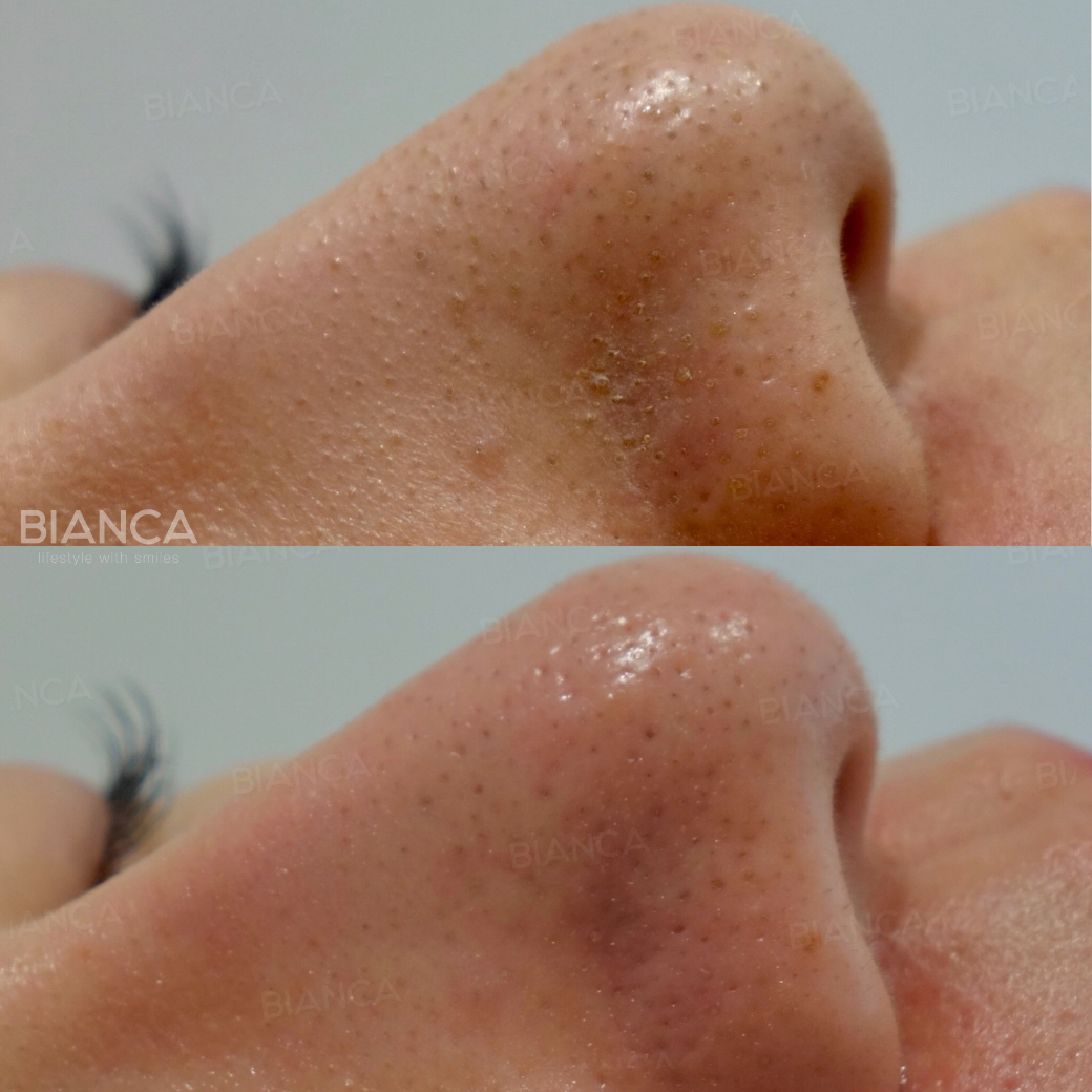 ハイドラフェイシャル（Hydrafacial）