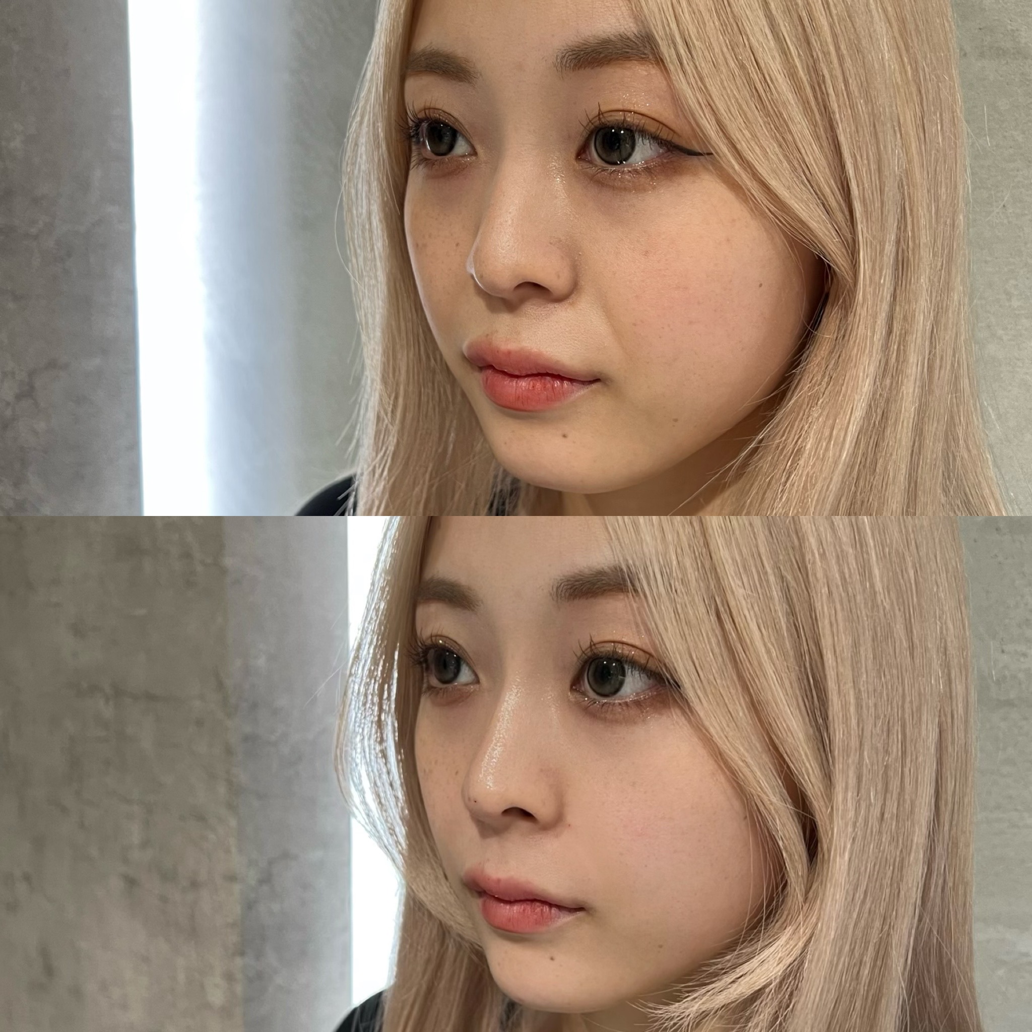 鼻とほうれい線と顎ヒアルロン酸注入