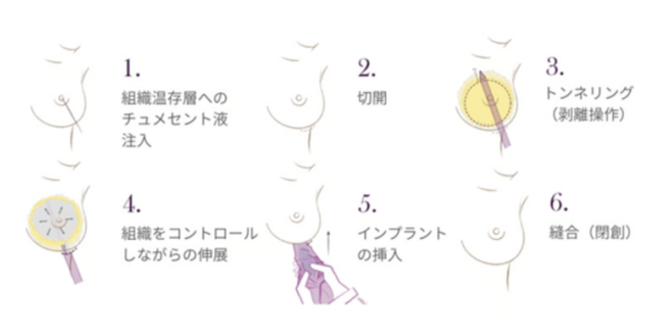 豊胸のデメリットとは？できなくなることが増えるって本当？｜ビアンカの美容外科医 雜賀 俊行が解説！