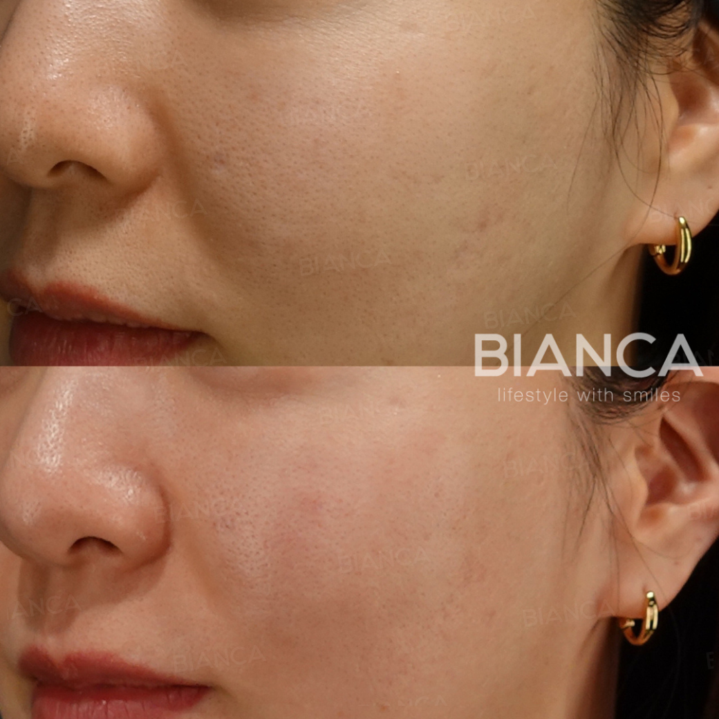 トライフィルプロ