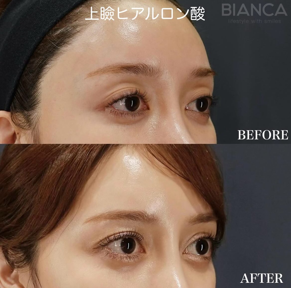 ヒアルロン酸注射（目の上）