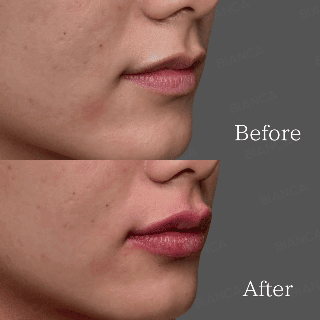 ヒアルロン酸注射（唇）