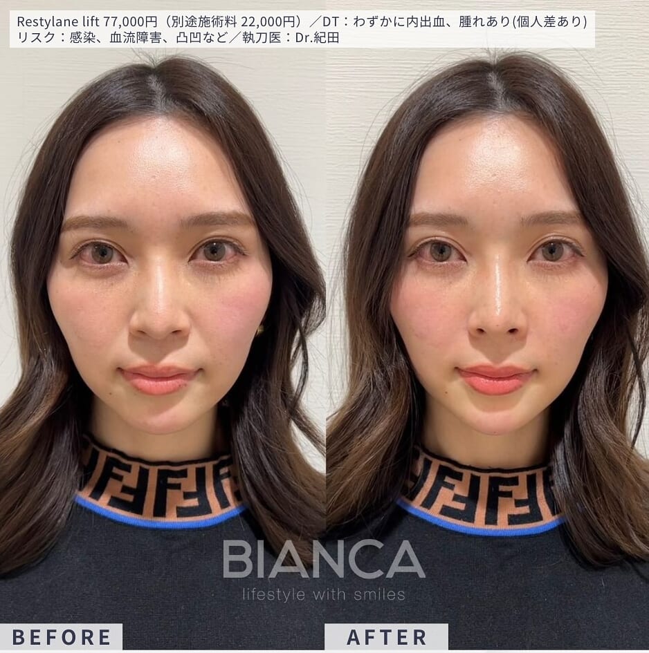 ヒアルロン酸注射（鼻翼基部）