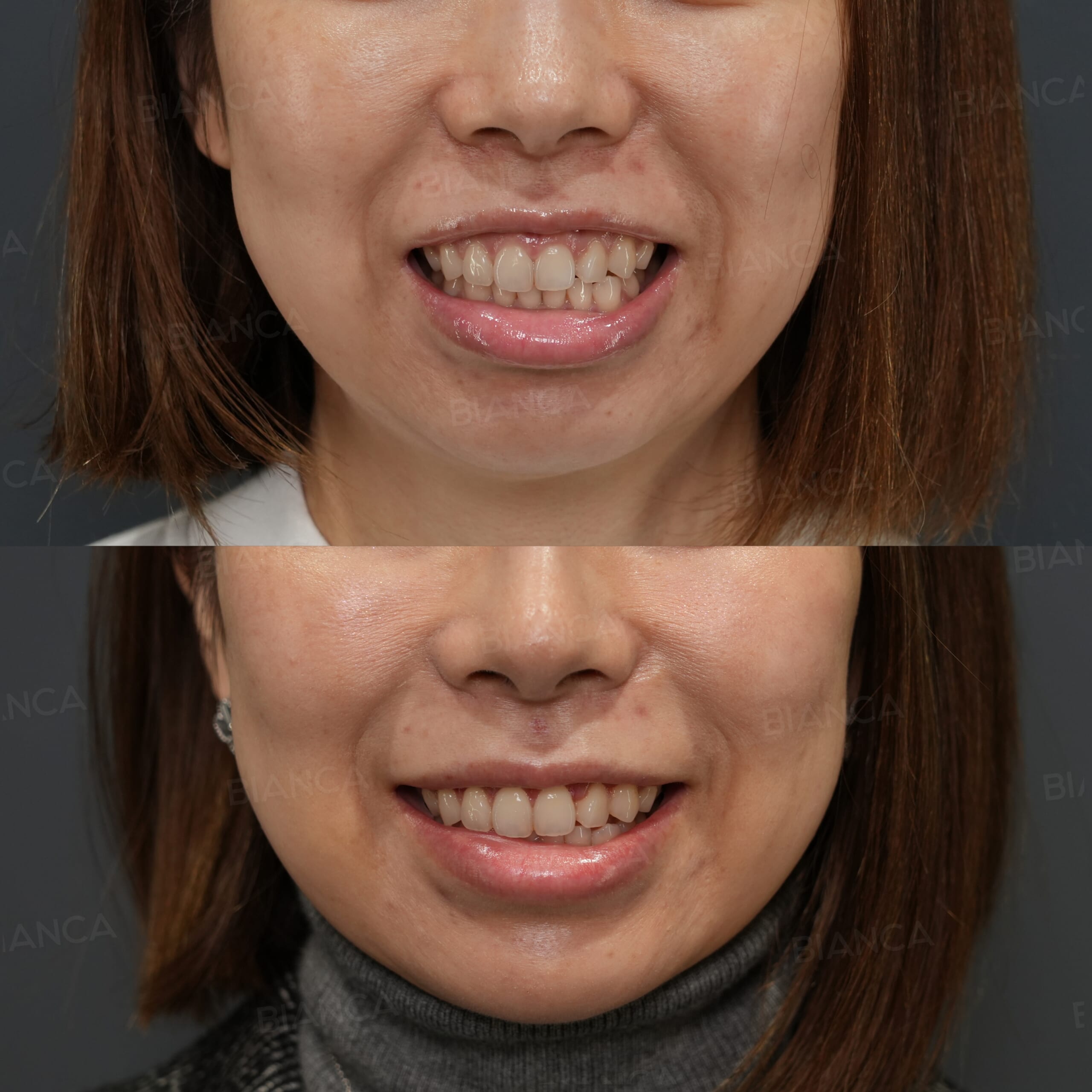 審美的歯冠長延長術