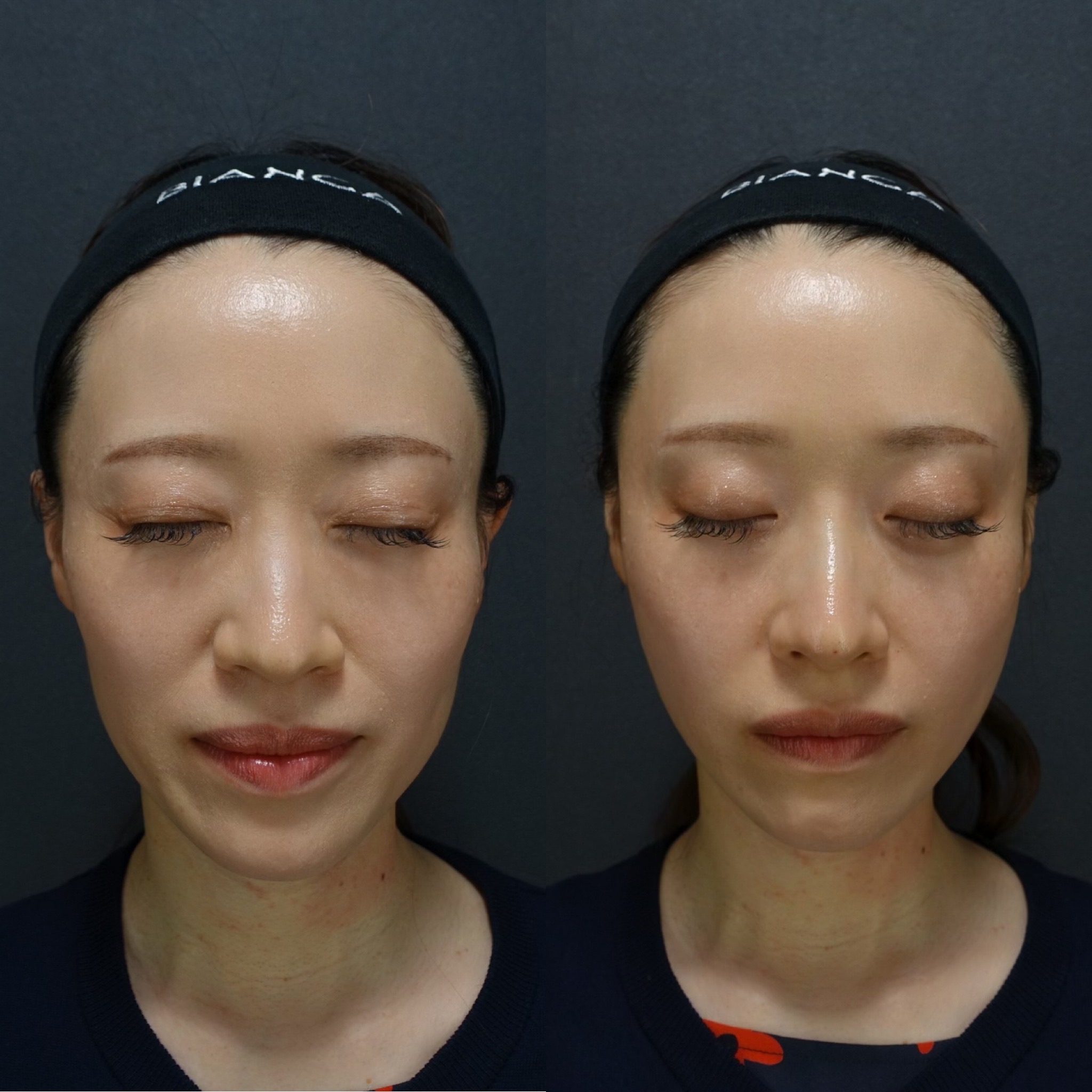 ヒアルロン酸注射