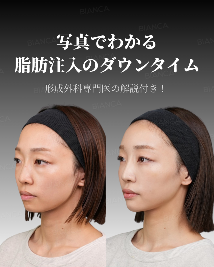 【時系列写真付】脱脂+全顔脂肪注入(CRF)のリアルなダウンタイムと過ごし方を紹介！