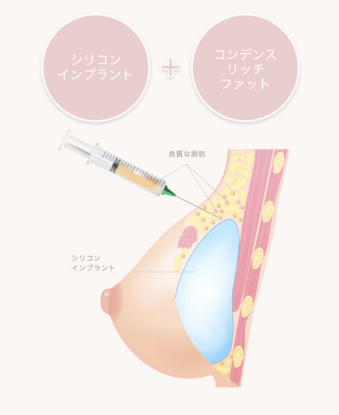 ハイブリッド豊胸銀座・表参道にあるBIANCA CLINIC ビアンカクリニック｜美容外科・美容皮膚科・再生医療・美容婦人科・美容内科・医療アートメイク