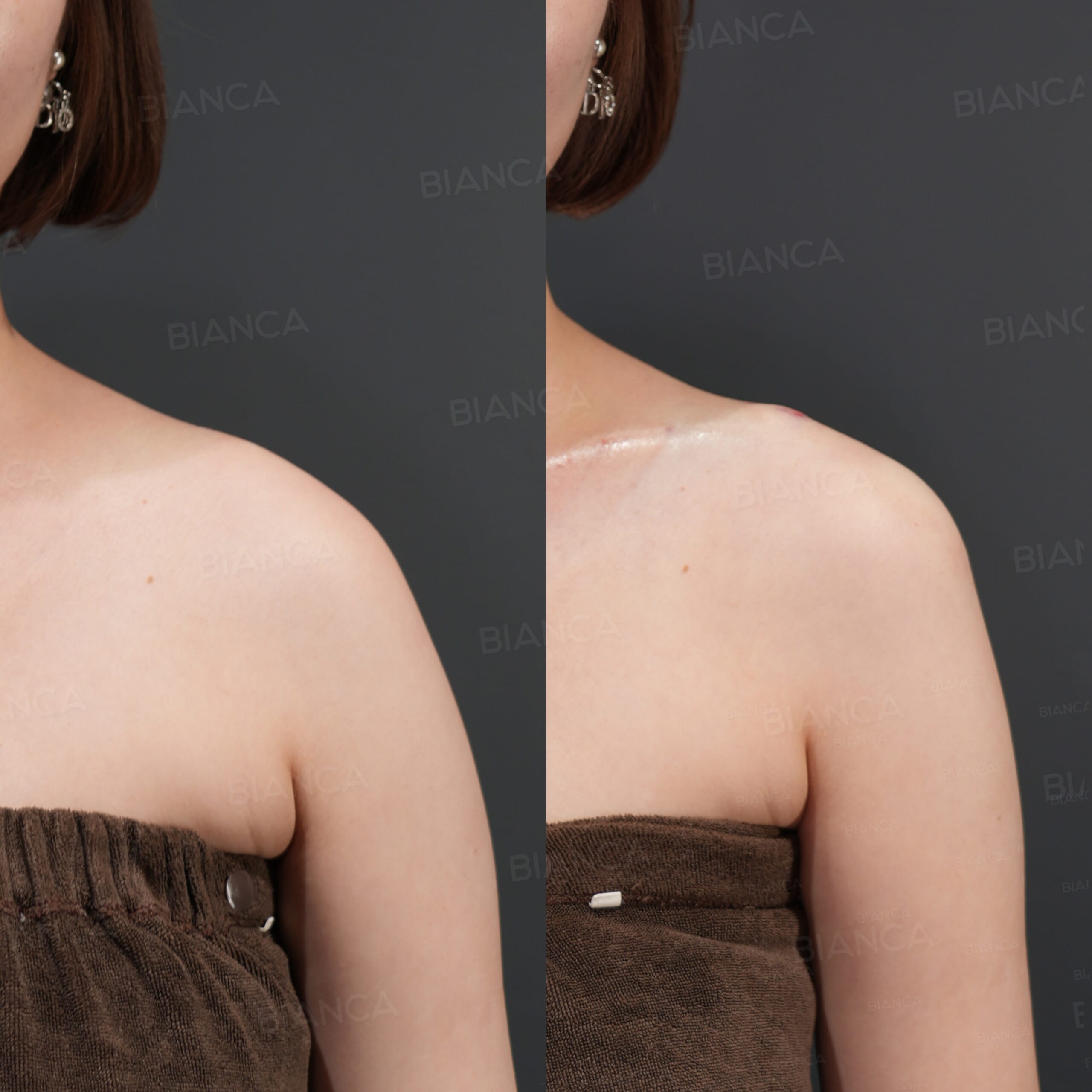 ヒアルロン酸注射（肩・鎖骨）