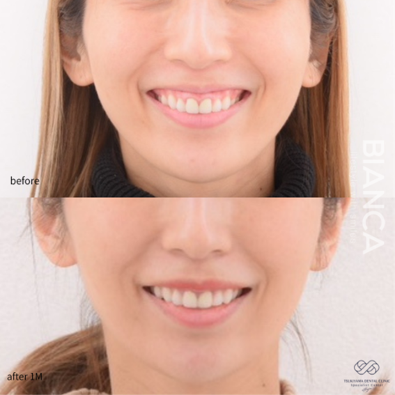 リップリポジショニング（上唇粘膜切除術）