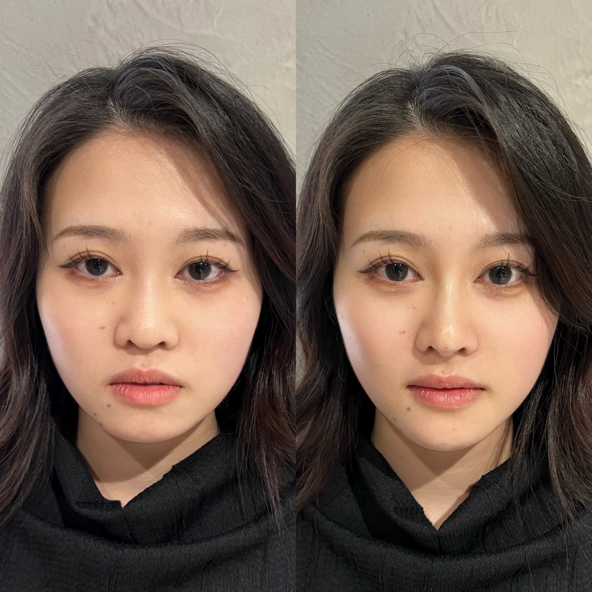 鼻と顎のヒアルロン酸注入