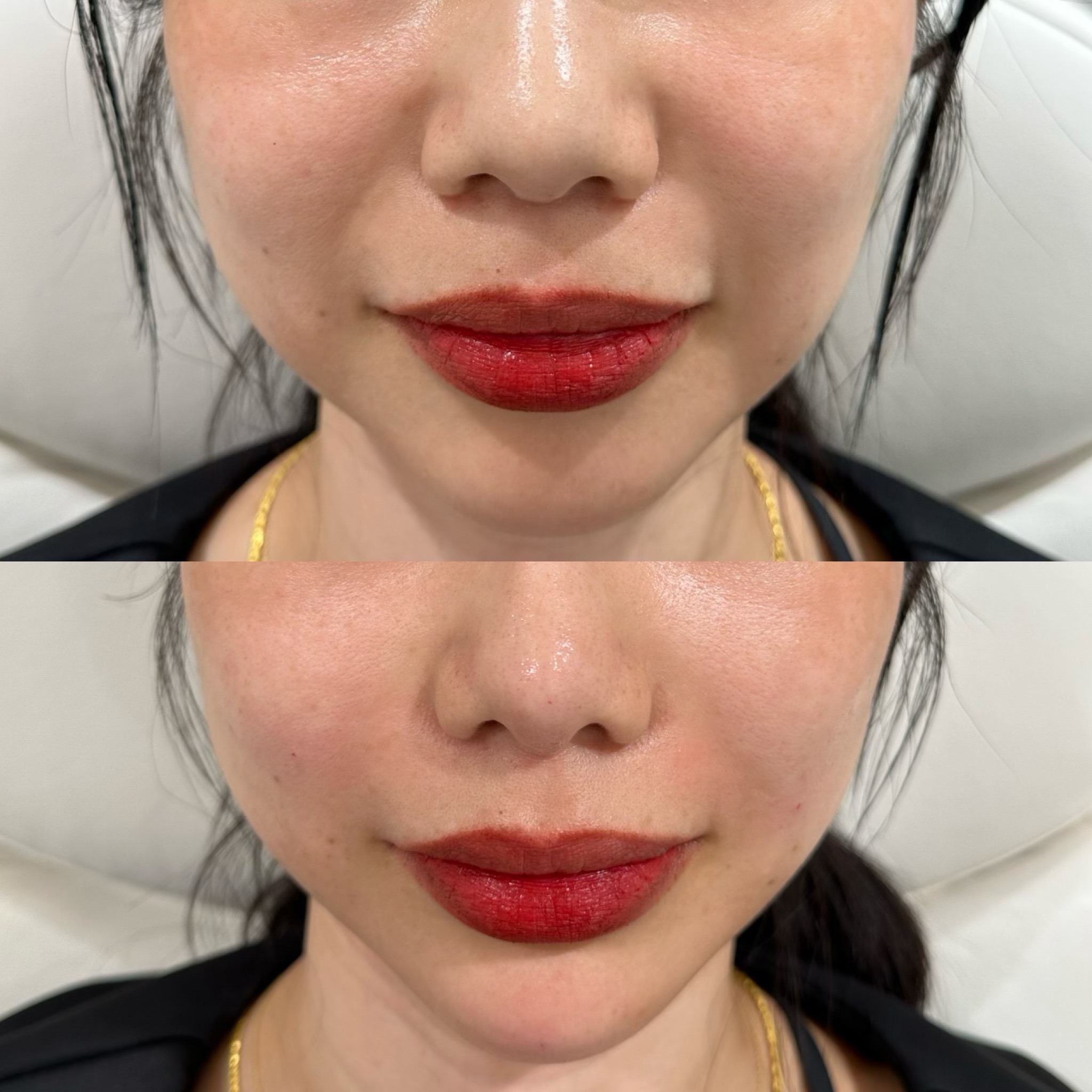 ヒアルロン酸注射（ほうれい線）