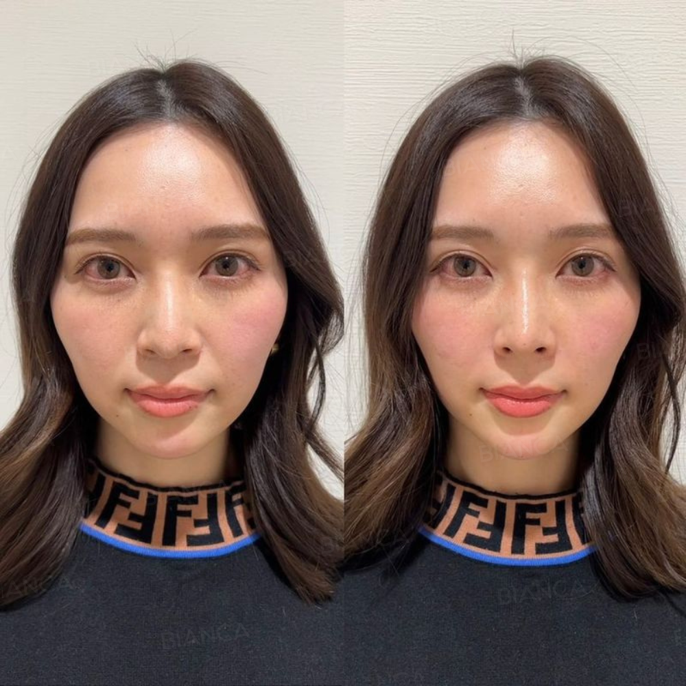 ヒアルロン酸注射（ほうれい線）