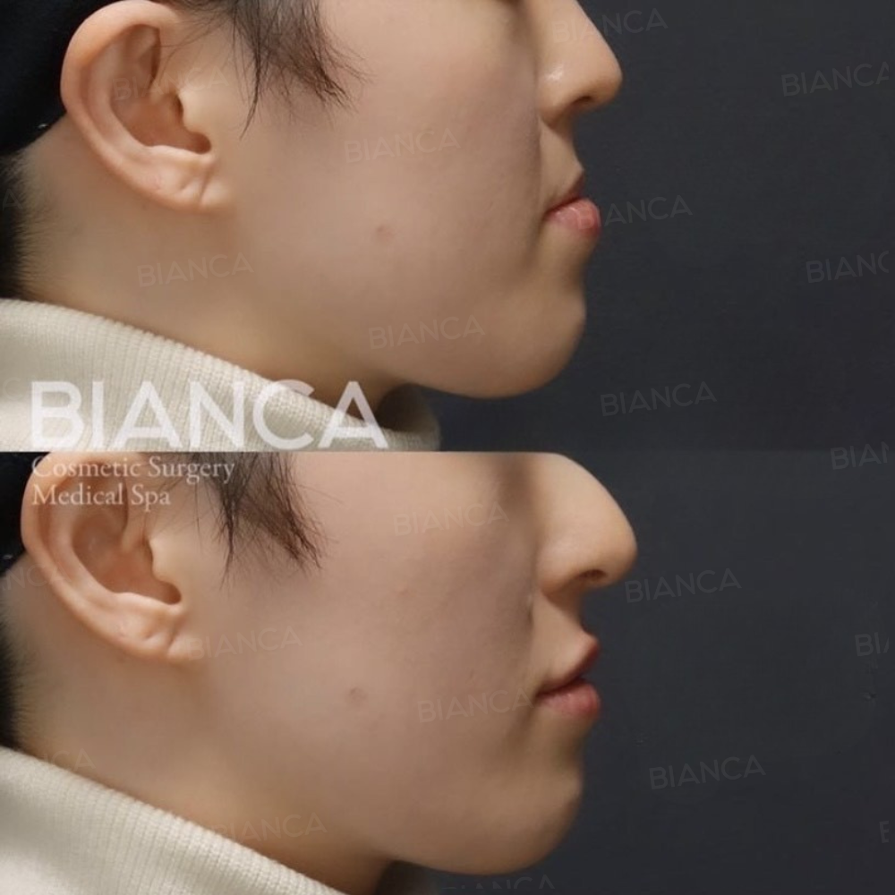 ヒアルロン酸注射（唇）