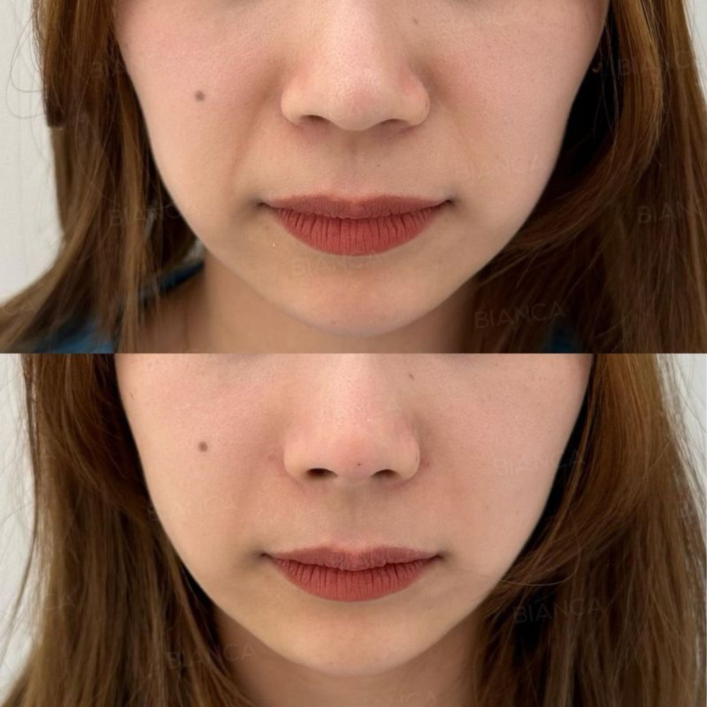 鼻とほうれい線のヒアルロン酸注入