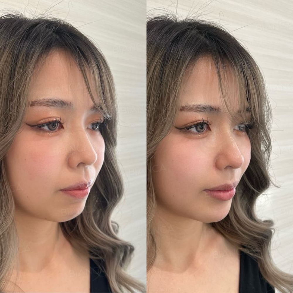 鼻とほうれい線と顎ヒアルロン酸注入