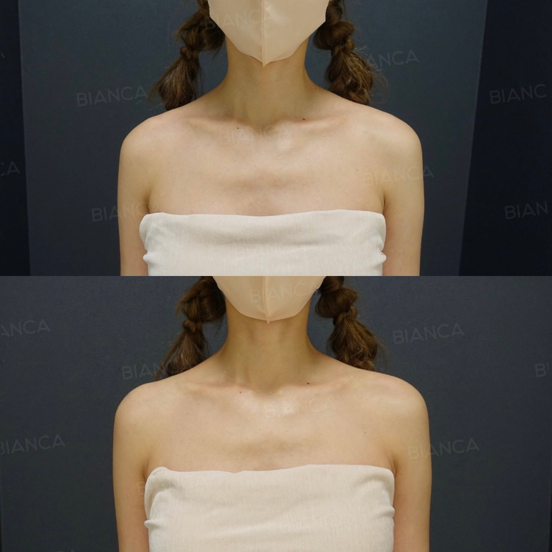 ヒアルロン酸注射（肩）