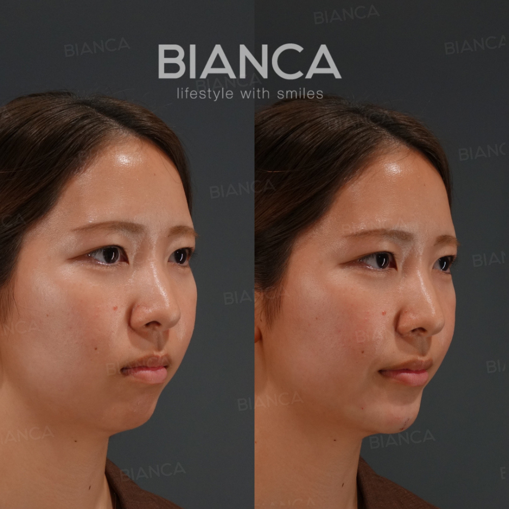 鼻と顎のヒアルロン酸注入