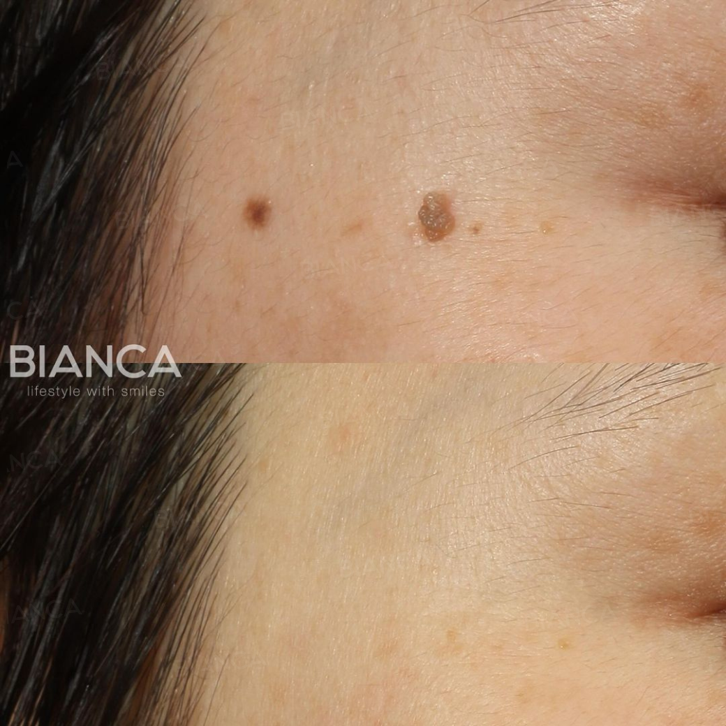 CO2レーザー（ホクロ・イボ取り）